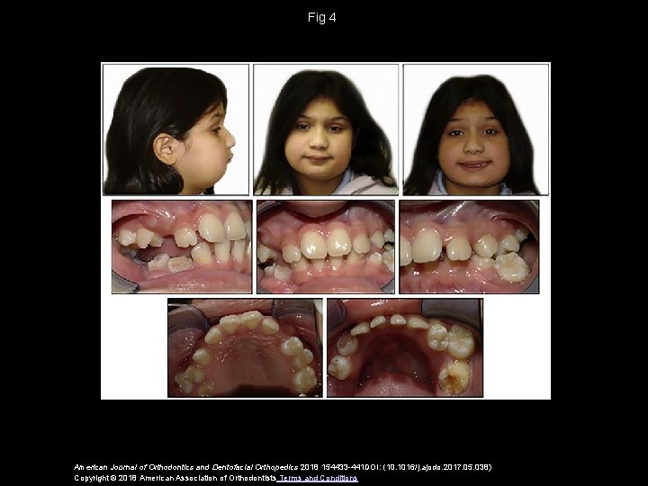 Fig 4 American Journal of Orthodontics and Dentofacial Orthopedics 2018 154433 -441 DOI: (10.