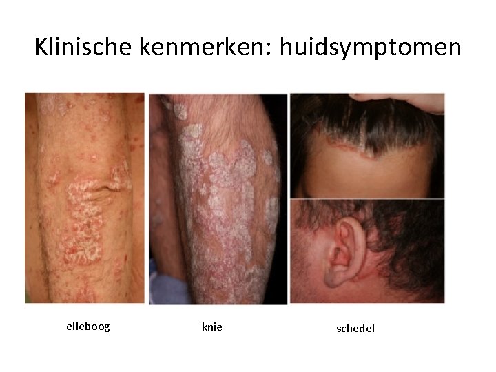 Klinische kenmerken: huidsymptomen elleboog knie schedel 