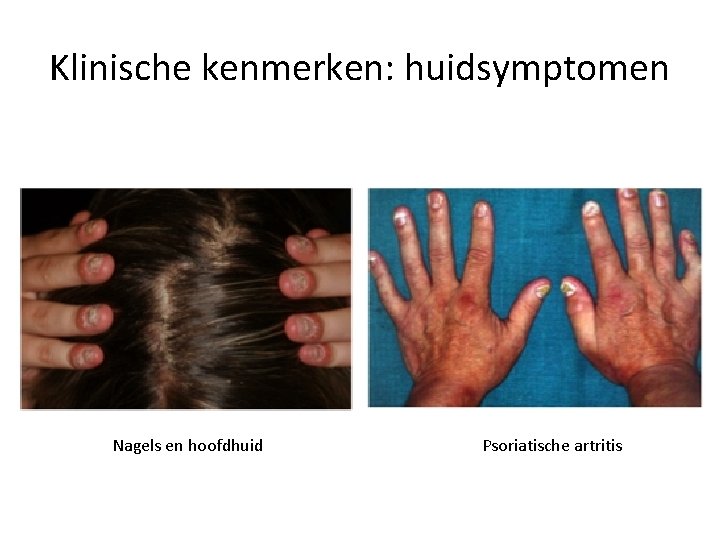 Klinische kenmerken: huidsymptomen Nagels en hoofdhuid Psoriatische artritis 