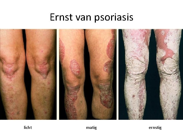 Ernst van psoriasis licht matig ernstig 