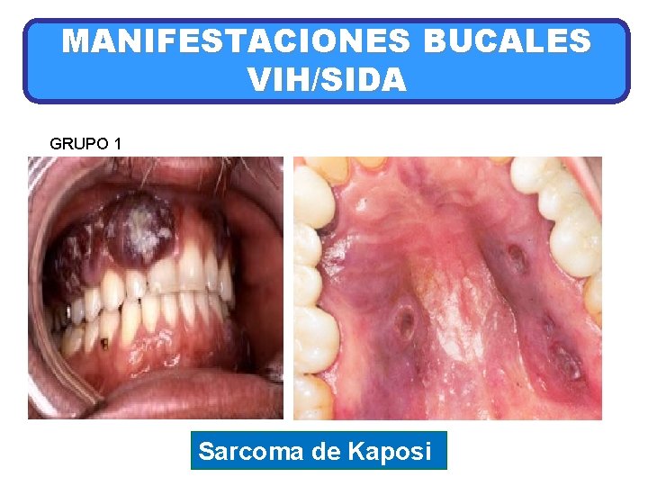 MANIFESTACIONES BUCALES VIH/SIDA GRUPO 1 Sarcoma de Kaposi 