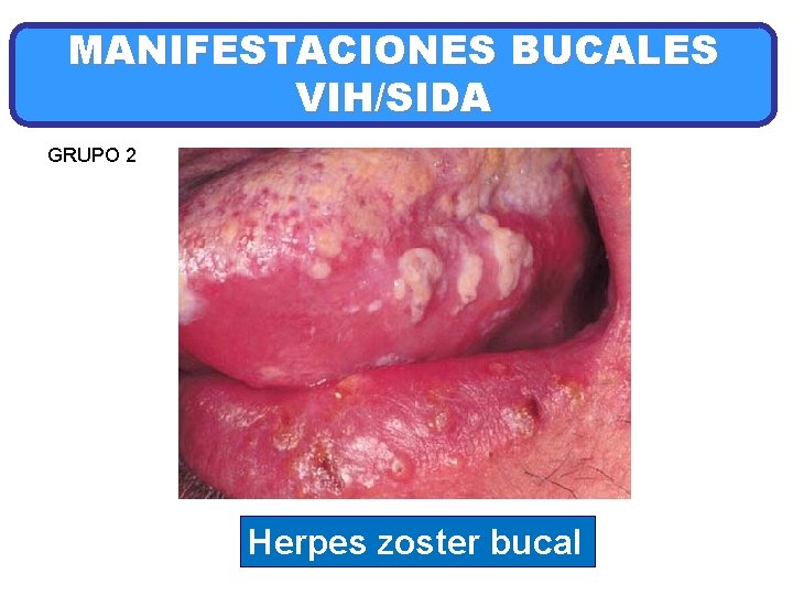MANIFESTACIONES BUCALES VIH/SIDA GRUPO 2 Herpes zoster bucal 