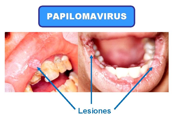 PAPILOMAVIRUS Lesiones 