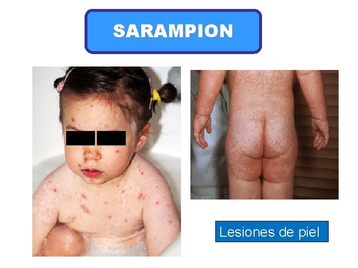 SARAMPION Lesiones de piel 