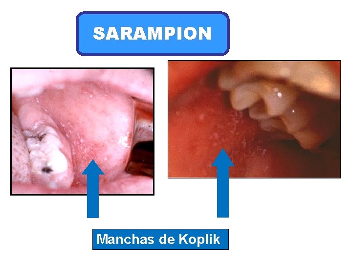 SARAMPION Manchas de Koplik 