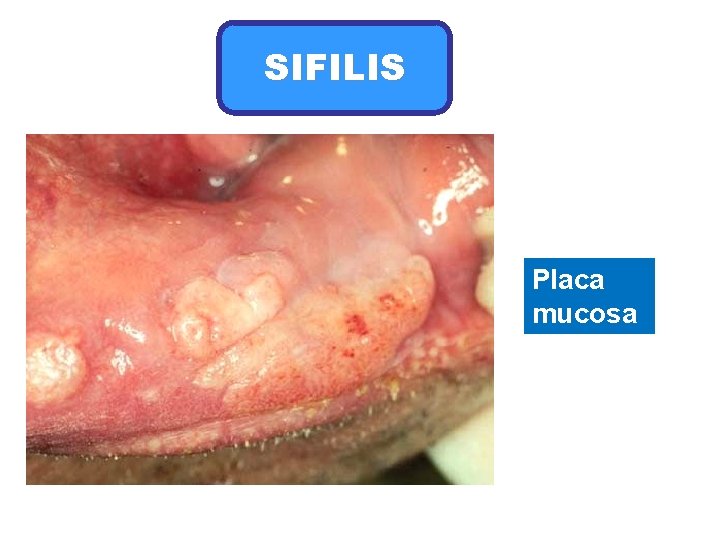 SIFILIS Placa mucosa 