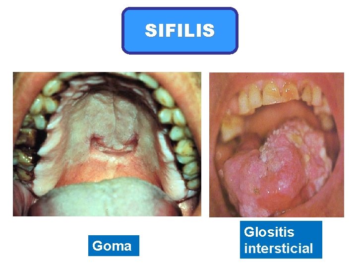 SIFILIS Goma Glositis intersticial 
