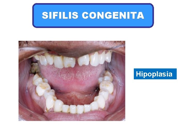 SIFILIS CONGENITA Hipoplasia 