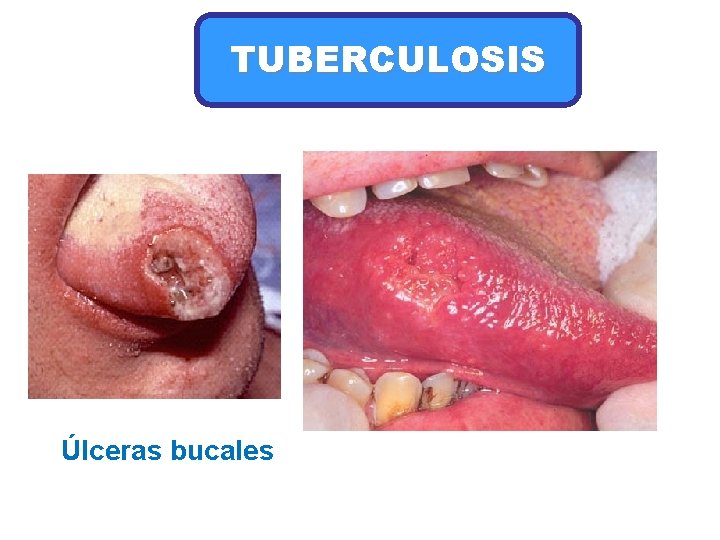 TUBERCULOSIS Úlceras bucales 