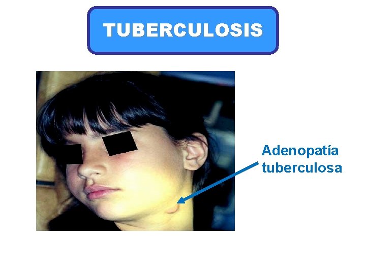 TUBERCULOSIS Adenopatía tuberculosa 