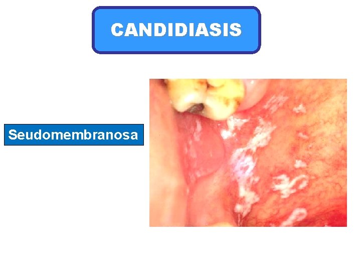 CANDIDIASIS Seudomembranosa 