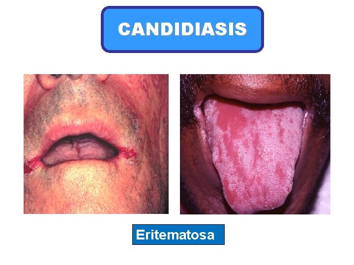 CANDIDIASIS Eritematosa 