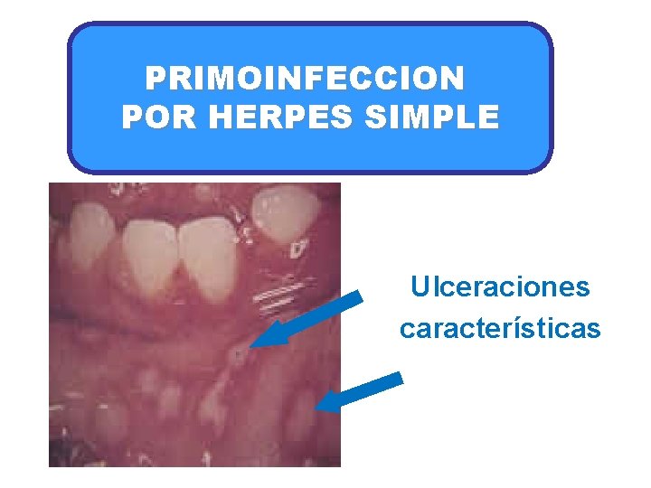 PRIMOINFECCION POR HERPES SIMPLE Ulceraciones características 