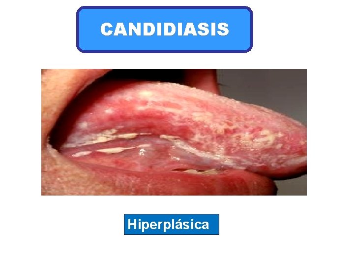 CANDIDIASIS Hiperplásica 