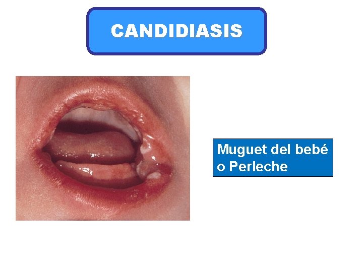 CANDIDIASIS Muguet del bebé o Perleche 