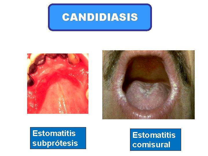 CANDIDIASIS Estomatitis subprótesis Estomatitis comisural 