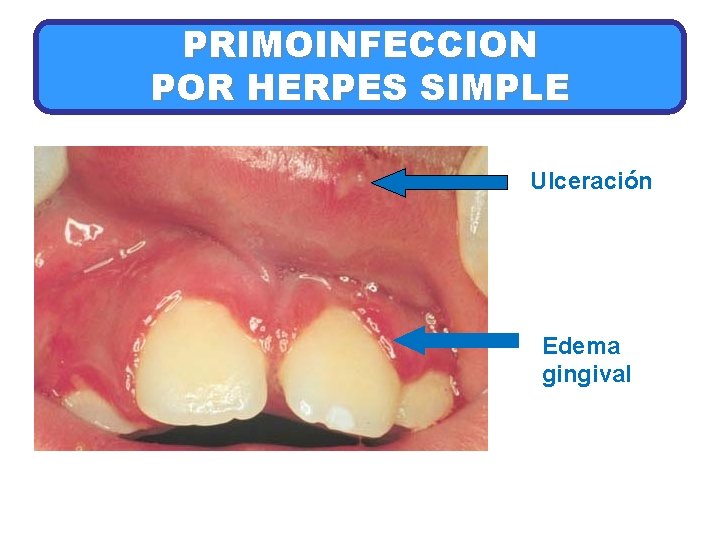 PRIMOINFECCION POR HERPES SIMPLE Ulceración Edema gingival 