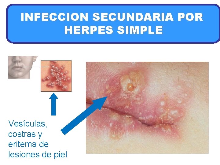 INFECCION SECUNDARIA POR HERPES SIMPLE Vesículas, costras y eritema de lesiones de piel 