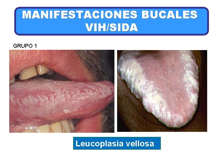 MANIFESTACIONES BUCALES VIH/SIDA GRUPO 1 Leucoplasia vellosa 