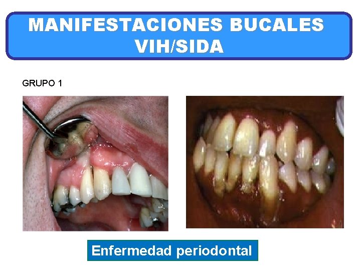 MANIFESTACIONES BUCALES VIH/SIDA GRUPO 1 Enfermedad periodontal 
