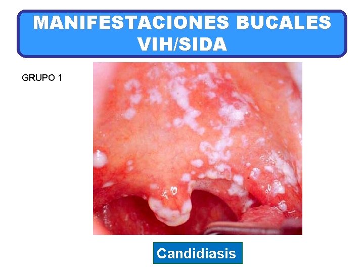 MANIFESTACIONES BUCALES VIH/SIDA GRUPO 1 Candidiasis 