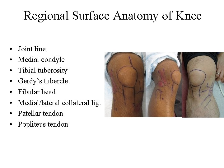 Regional Surface Anatomy of Knee • • Joint line Medial condyle Tibial tuberosity Gerdy’s