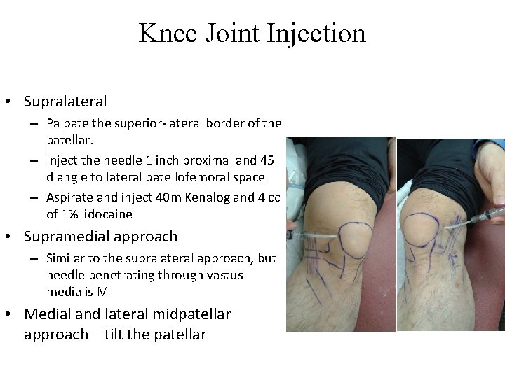 Knee Joint Injection • Supralateral – Palpate the superior-lateral border of the patellar. –