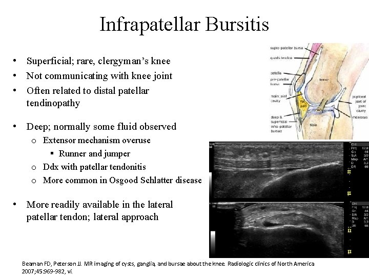 Infrapatellar Bursitis • Superficial; rare, clergyman’s knee • Not communicating with knee joint •