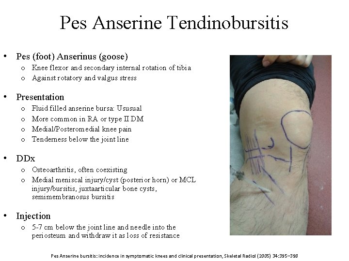 Pes Anserine Tendinobursitis • Pes (foot) Anserinus (goose) o Knee flexor and secondary internal