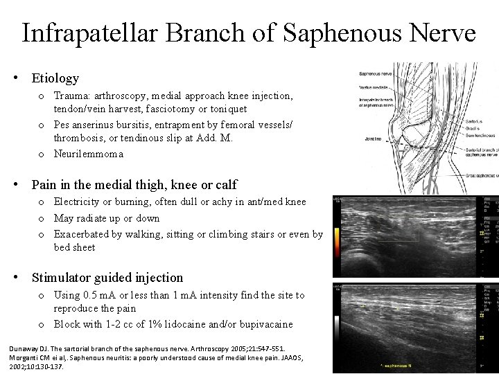 Infrapatellar Branch of Saphenous Nerve • Etiology o Trauma: arthroscopy, medial approach knee injection,