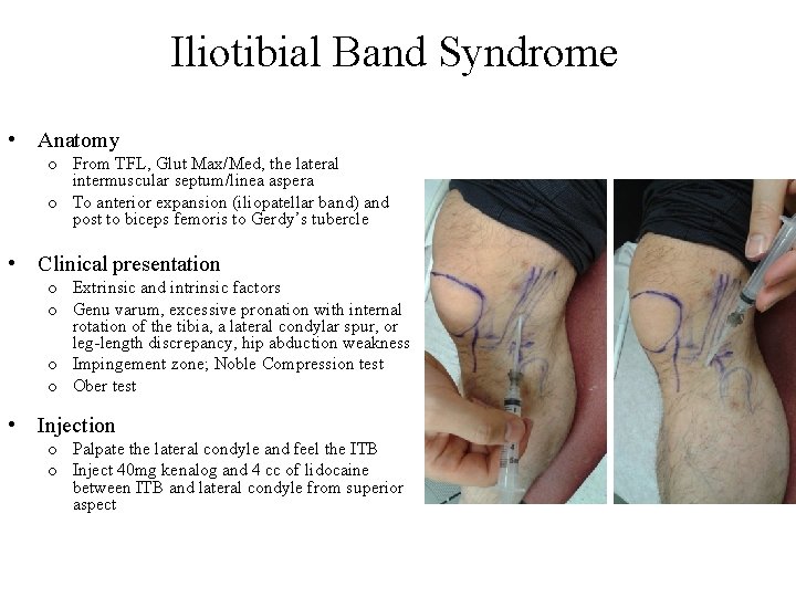 Iliotibial Band Syndrome • Anatomy o From TFL, Glut Max/Med, the lateral intermuscular septum/linea
