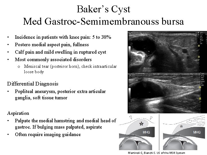 Baker’s Cyst Med Gastroc-Semimembranouss bursa • • Incidence in patients with knee pain: 5