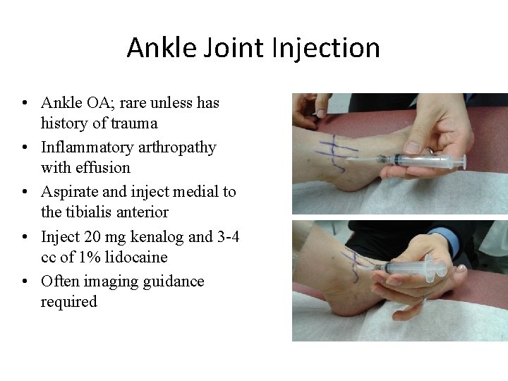 Ankle Joint Injection • Ankle OA; rare unless has history of trauma • Inflammatory