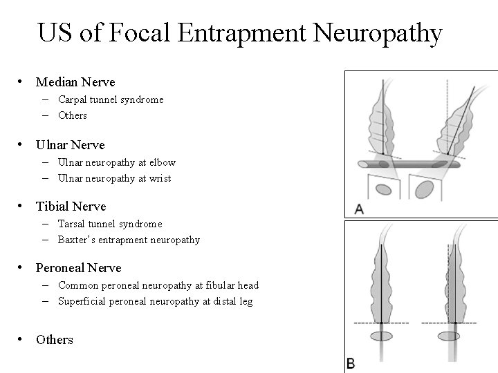 US of Focal Entrapment Neuropathy • Median Nerve – Carpal tunnel syndrome – Others
