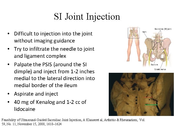 SI Joint Injection • Difficult to injection into the joint without imaging guidance •