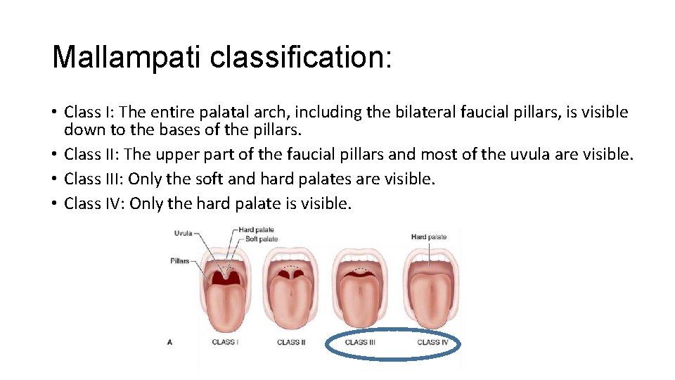 Mallampati classification: • Class I: The entire palatal arch, including the bilateral faucial pillars,