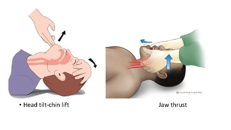  • Head tilt-chin lift Jaw thrust 