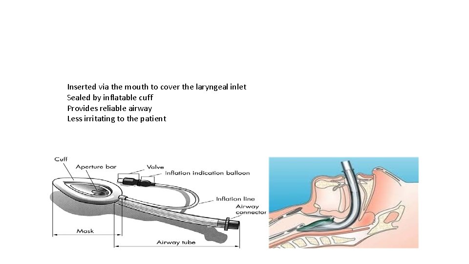 Inserted via the mouth to cover the laryngeal inlet Sealed by inflatable cuff Provides