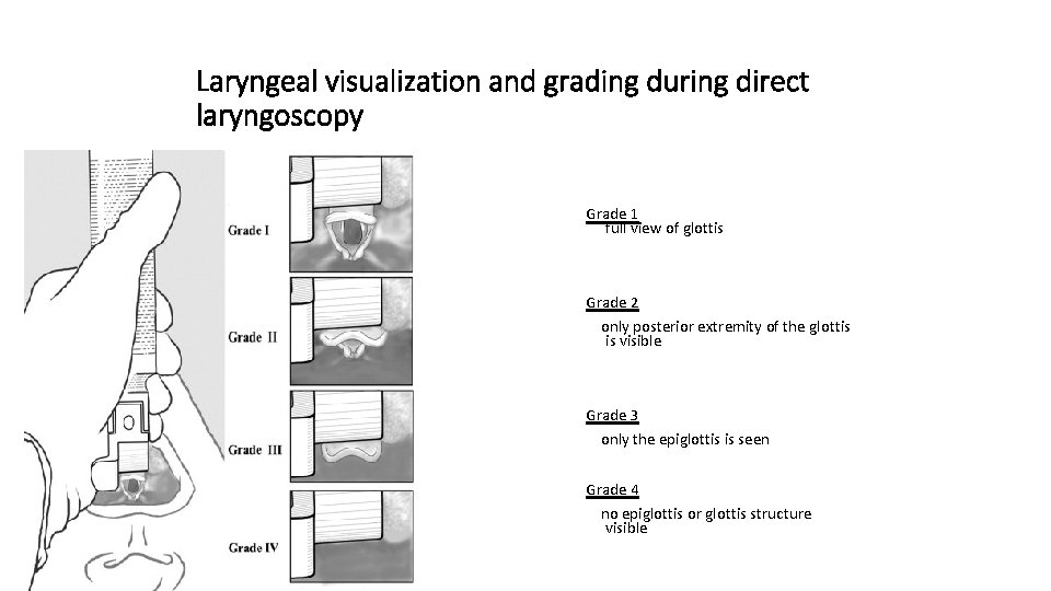 Laryngeal visualization and grading during direct laryngoscopy Grade 1 full view of glottis Grade
