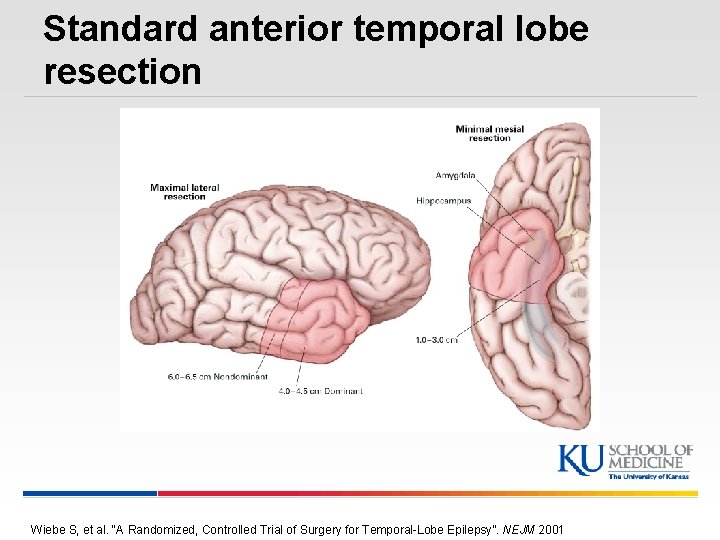 Standard anterior temporal lobe resection Wiebe S, et al. “A Randomized, Controlled Trial of