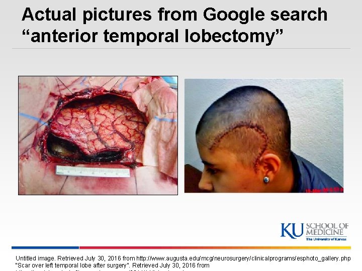Actual pictures from Google search “anterior temporal lobectomy” Untitled image. Retrieved July 30, 2016