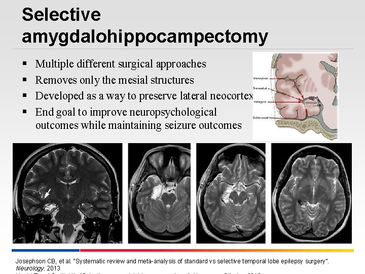 Selective amygdalohippocampectomy § § Multiple different surgical approaches Removes only the mesial structures Developed