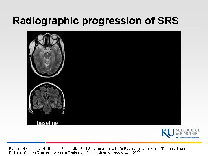 Radiographic progression of SRS Barbaro NM, et al. “A Multicenter, Prospective Pilot Study of