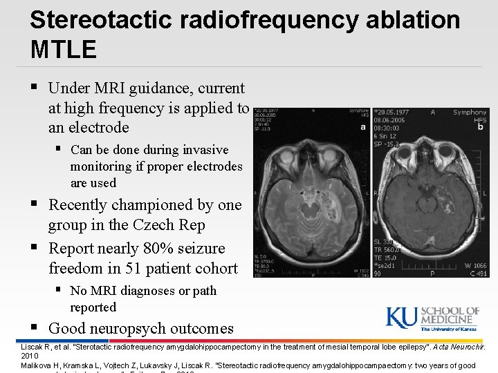 Stereotactic radiofrequency ablation MTLE § Under MRI guidance, current at high frequency is applied