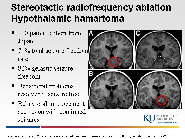 Stereotactic radiofrequency ablation Hypothalamic hamartoma § 100 patient cohort from § § Japan 71%