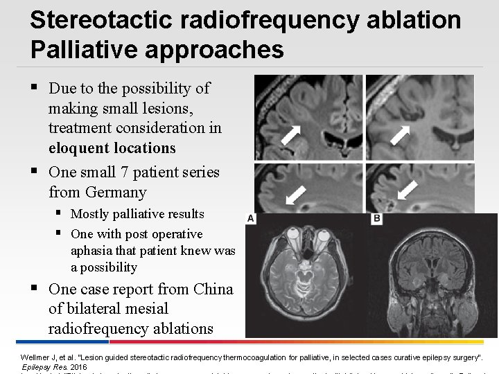 Stereotactic radiofrequency ablation Palliative approaches § Due to the possibility of making small lesions,