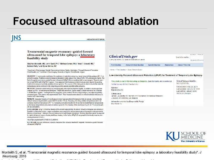 Focused ultrasound ablation Monteith S, et al. “Transcranial magnetic resonance-guided focused ultrasound for temporal