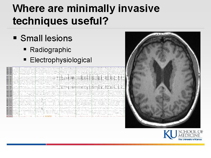 Where are minimally invasive techniques useful? § Small lesions § Radiographic § Electrophysiological §