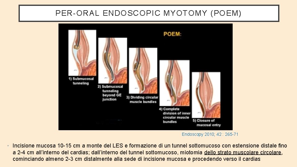 PER-ORAL ENDOSCOPIC MYOTOMY (POEM) Endoscopy 2010; 42 : 265 -71 • Incisione mucosa 10
