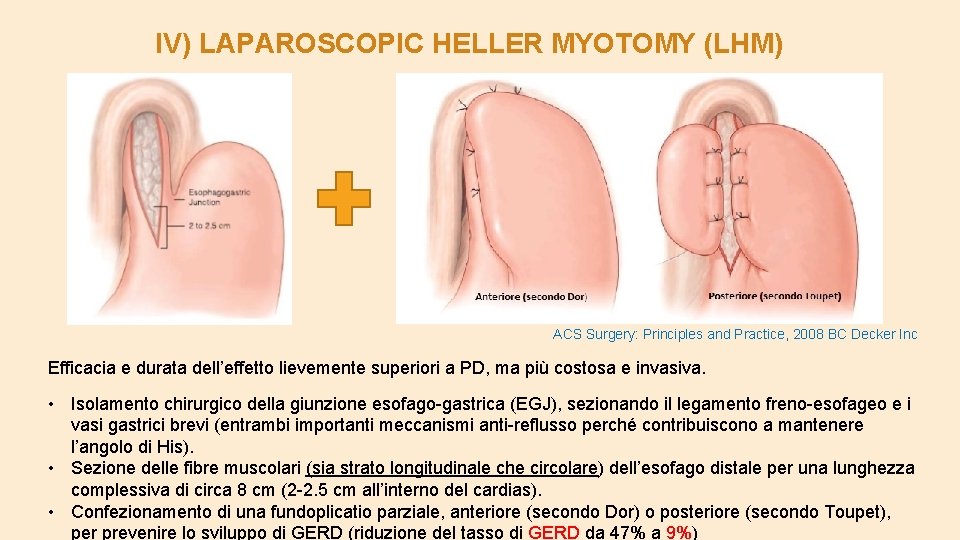 IV) LAPAROSCOPIC HELLER MYOTOMY (LHM) ACS Surgery: Principles and Practice, 2008 BC Decker Inc